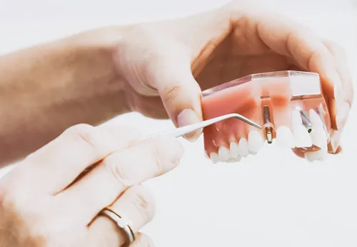 Implantes Dentales Marbella