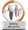 Dental Implants Marbella