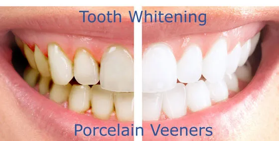 Tooth whitening and veneers Marbella