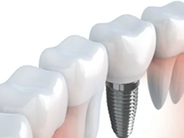 Implant Dentaire Marbella
