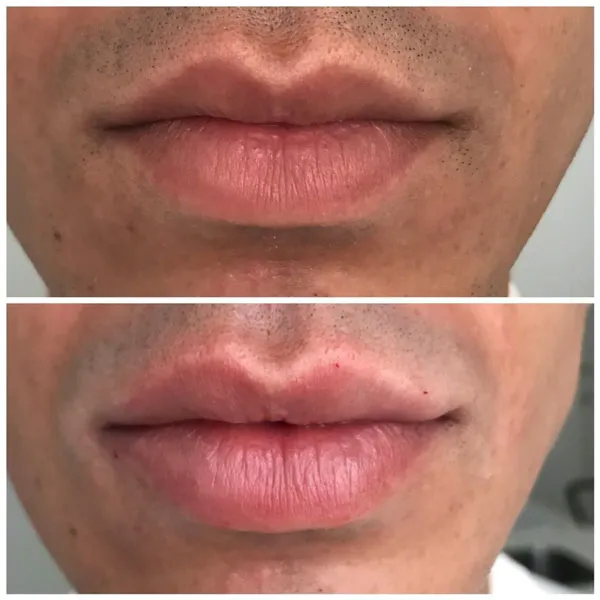 Relleno de labios Marbeclinic